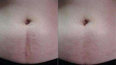 激光<a href=http://www.f3bb6.cn/listinfo-783-0.html target=_blank class=infotextkey>祛疤</a>好嗎