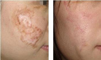 激光<a href=http://www.f3bb6.cn/listinfo-783-0.html target=_blank class=infotextkey>祛疤</a>到底有效果嗎