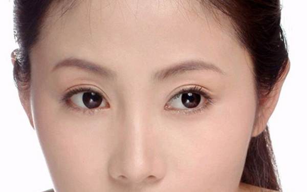 開內眼角增生會好嗎