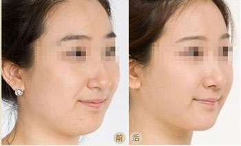 <a href=http://www.f3bb6.cn/listinfo-631-0.html target=_blank class=infotextkey>瘦臉</a><a href=http://www.f3bb6.cn/listinfo-614-0.html target=_blank class=infotextkey>除皺</a>效果較好的時(shí)間