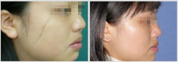 劃傷疤痕怎么去除