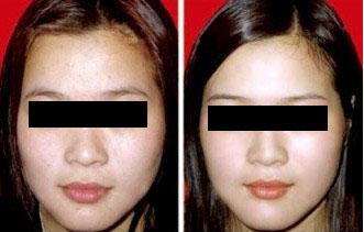 復合彩光<a href=http://www.f3bb6.cn/listinfo-795-0.html target=_blank class=infotextkey>祛斑</a>效果好嗎