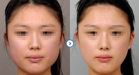  <a href=http://www.f3bb6.cn/listinfo-631-0.html target=_blank class=infotextkey>瘦臉</a><a href=http://www.f3bb6.cn/listinfo-614-0.html target=_blank class=infotextkey>除皺</a>有什么危害嗎