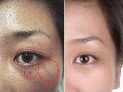 臉上疤掉了黑印怎么辦