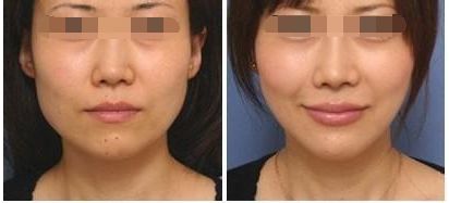 怎樣<a href=http://www.f3bb6.cn/listinfo-631-0.html target=_blank class=infotextkey>瘦臉</a>小竅門快