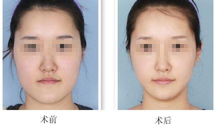 <a href=http://www.f3bb6.cn/listinfo-631-0.html target=_blank class=infotextkey>瘦臉</a><a href=http://www.f3bb6.cn/listinfo-614-0.html target=_blank class=infotextkey>除皺</a>有沒有副作用