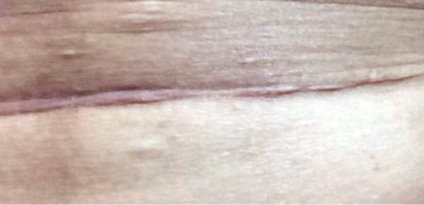 疤痕增生用什么藥膏