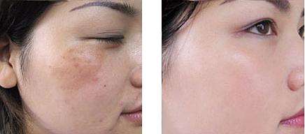 牙膏加什么可快速<a href=http://www.f3bb6.cn/listinfo-795-0.html target=_blank class=infotextkey>祛斑</a>