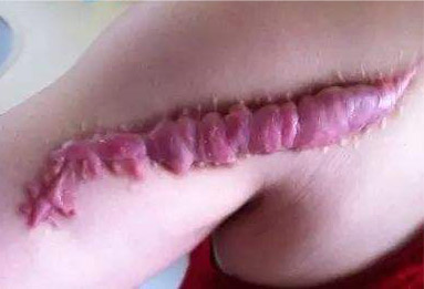 疤痕增生多久可以變平