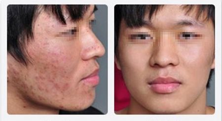 紅色痘印怎么消除