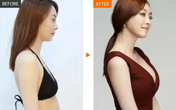 妙桃<a href=http://www.f3bb6.cn/listinfo-618-0.html target=_blank class=infotextkey>隆胸</a>的須知事項