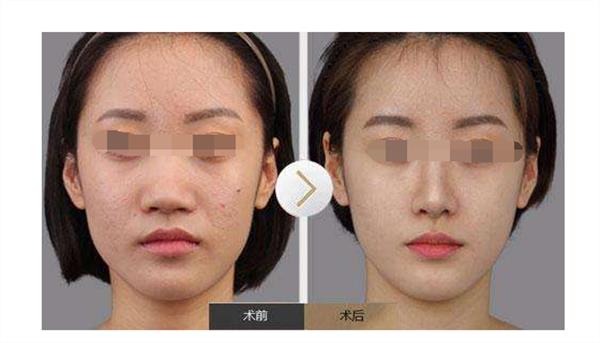 <a href=http://www.f3bb6.cn/listinfo-754-0.html target=_blank class=infotextkey>鼻翼</a>縮小術(shù)后護(hù)理措施有哪些