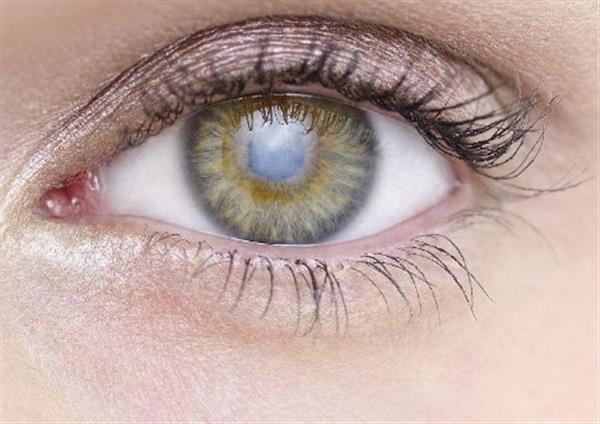 眼苔修復手術有哪些情況