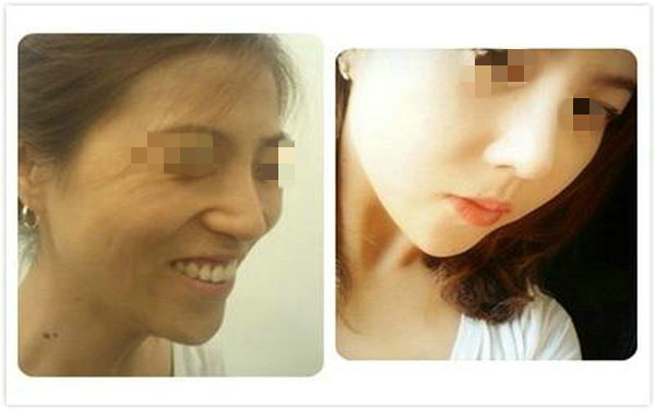 做透明質酸<a href=http://www.f3bb6.cn/listinfo-737-0.html target=_blank class=infotextkey>隆鼻</a>注意事項？