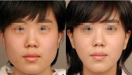 <a href=http://www.f3bb6.cn/listinfo-631-0.html target=_blank class=infotextkey>瘦臉</a><a href=http://www.f3bb6.cn/listinfo-614-0.html target=_blank class=infotextkey>除皺</a>正規醫院多少錢