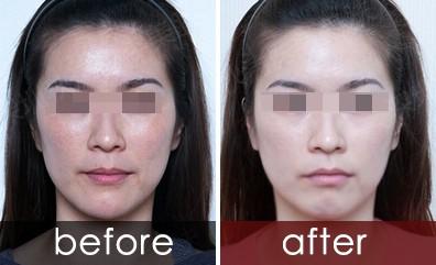 彩光<a href=http://www.f3bb6.cn/listinfo-770-0.html target=_blank class=infotextkey>嫩膚</a>價(jià)格大概是多少