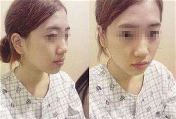 韓式整容手術有哪些優點