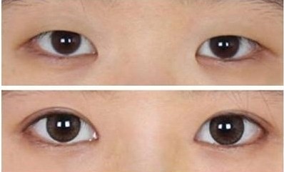 <a href=http://www.f3bb6.cn/listinfo-711-0.html target=_blank class=infotextkey>開眼角</a>恢復(fù)期是多久