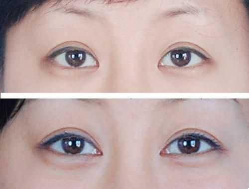 開個眼角需要多少錢