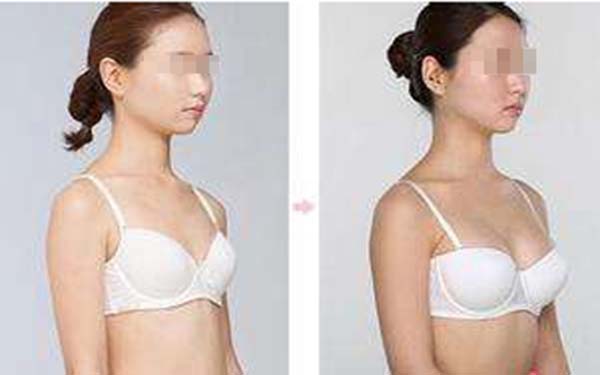 妙桃<a href=http://www.f3bb6.cn/listinfo-618-0.html target=_blank class=infotextkey>隆胸</a>材料特點(diǎn)