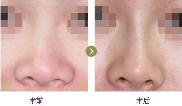 <a href=http://www.f3bb6.cn/listinfo-754-0.html target=_blank class=infotextkey>鼻翼</a>縮小手術做了后悔怎么辦