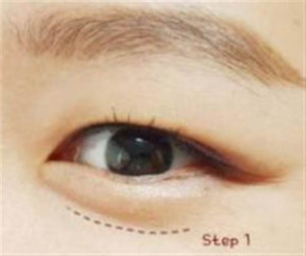 透明質酸注射<a href=http://www.f3bb6.cn/listinfo-722-0.html target=_blank class=infotextkey>臥蠶</a>多少錢