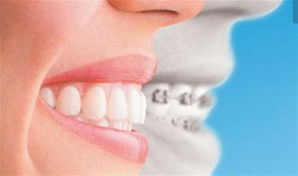牙列稀疏應(yīng)該要如何治療