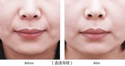 法令紋注射<a href=http://www.f3bb6.cn/listinfo-631-0.html target=_blank class=infotextkey>瘦臉</a><a href=http://www.f3bb6.cn/listinfo-614-0.html target=_blank class=infotextkey>除皺</a>后注意事項