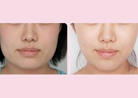 做一次<a href=http://www.f3bb6.cn/listinfo-629-0.html target=_blank class=infotextkey>下頜角</a><a href=http://www.f3bb6.cn/listinfo-10-0.html target=_blank class=infotextkey>整形價格</a>