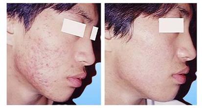 怎樣祛除臉上痘印疤痕