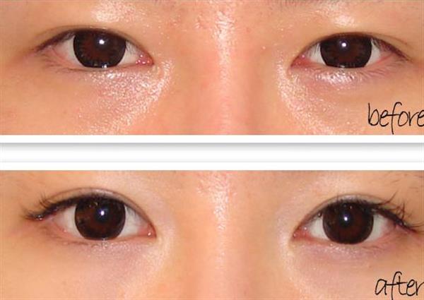 <a href=http://www.f3bb6.cn/listinfo-711-0.html target=_blank class=infotextkey>開眼角</a>手術優勢有哪些呢