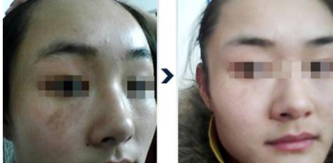 南京<a href=http://www.f3bb6.cn/listinfo-795-0.html target=_blank class=infotextkey>祛斑</a>的價(jià)格