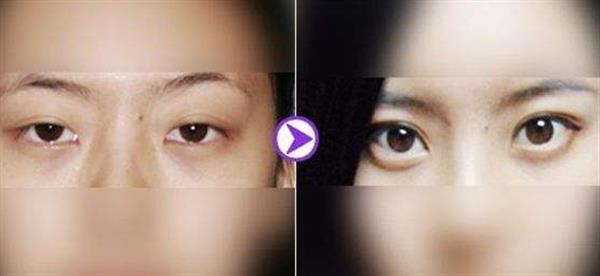 <a href=http://www.f3bb6.cn/listinfo-655-0.html target=_blank class=infotextkey>切眉</a>圖片對比照片