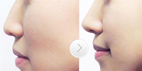 做假體鼻子多久才能恢復