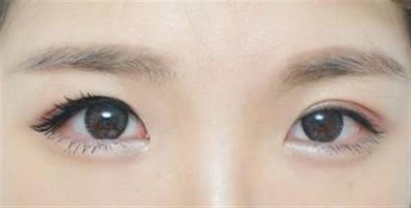 脂肪打<a href=http://www.f3bb6.cn/listinfo-722-0.html target=_blank class=infotextkey>臥蠶</a>多少錢