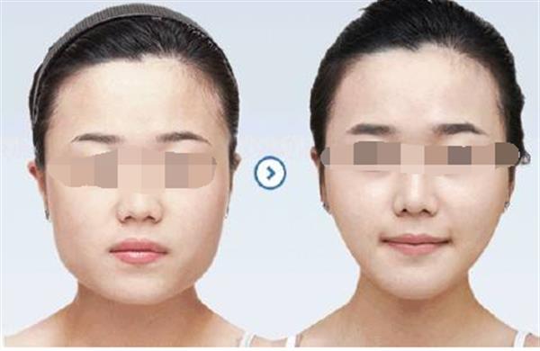 請問臉部輪廓整形要做什么手術(shù)