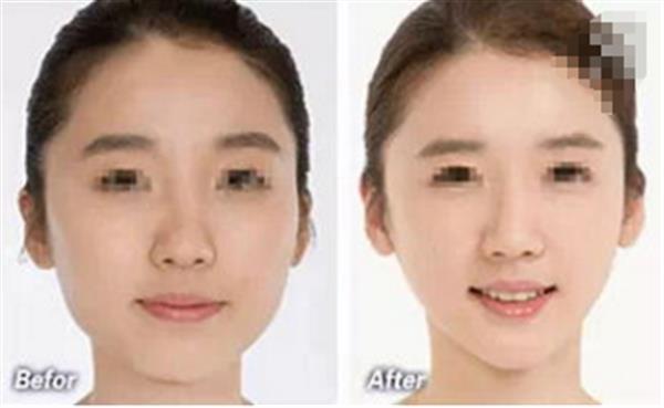 下巴栓塞有什么癥狀