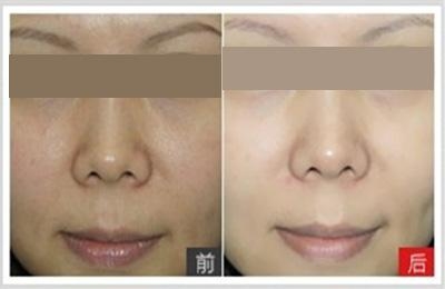 光子<a href=http://www.f3bb6.cn/listinfo-770-0.html target=_blank class=infotextkey>嫩膚</a>一次的效果怎么樣