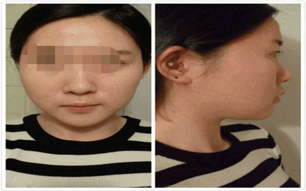 硅膠<a href=http://www.f3bb6.cn/listinfo-737-0.html target=_blank class=infotextkey>隆鼻</a>梁多少錢