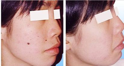 激光去痣多少錢