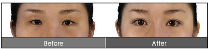 <a href=http://www.f3bb6.cn/listinfo-724-0.html target=_blank class=infotextkey>雙眼皮</a>手術失敗該如何補救呢