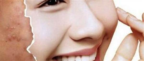 面部螨蟲和粉刺的區(qū)別