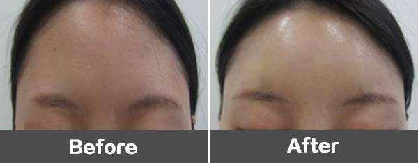 額部填充術的適應癥有哪些