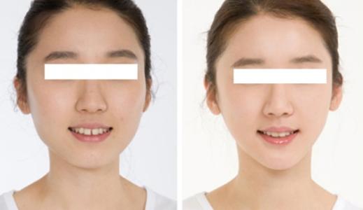膨體隆下巴手術(shù)優(yōu)勢有哪些