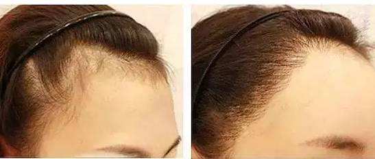 做<a href=http://www.f3bb6.cn/listinfo-664-0.html target=_blank class=infotextkey>毛發(fā)種植</a>手術需要多少錢
