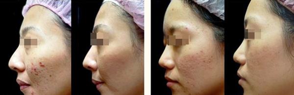 點陣激光后恢復過程圖