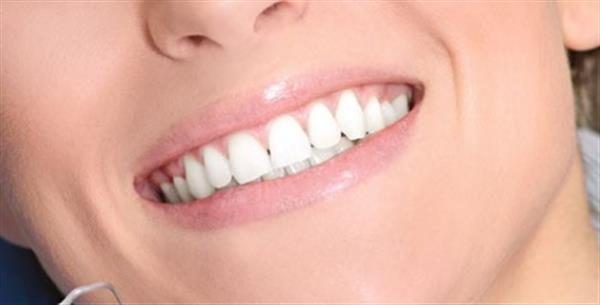 影響全瓷牙價格的因素