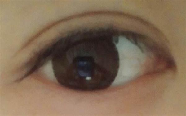 如何應對埋線<a href=http://www.f3bb6.cn/listinfo-724-0.html target=_blank class=infotextkey>雙眼皮</a>浮腫