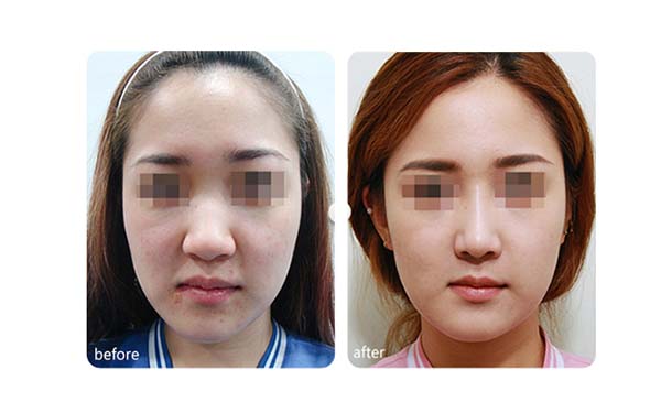 左右臉不對稱為何引起