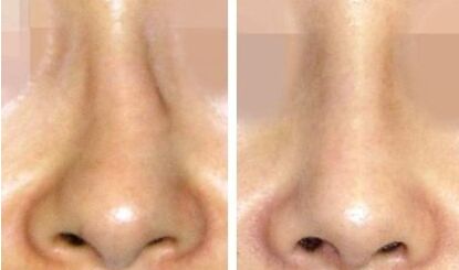 <a href=http://www.f3bb6.cn/listinfo-751-0.html target=_blank class=infotextkey>歪鼻矯正</a>整形術(shù)后如何護(hù)理